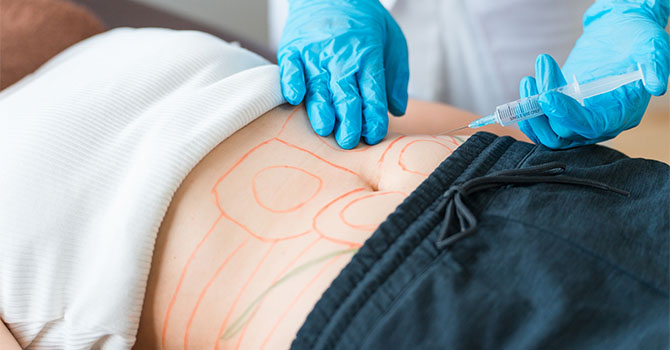 脂肪吸引の施術の様子